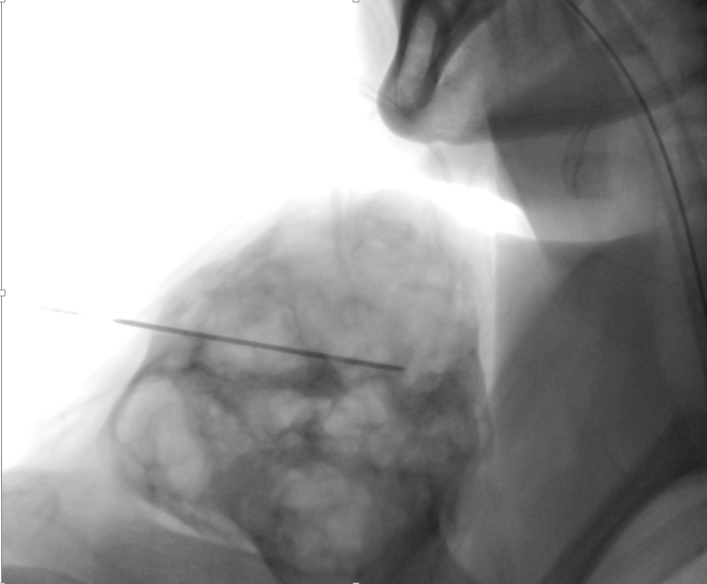 Terapia esclerosante del Quiste Óseo Aneurismático